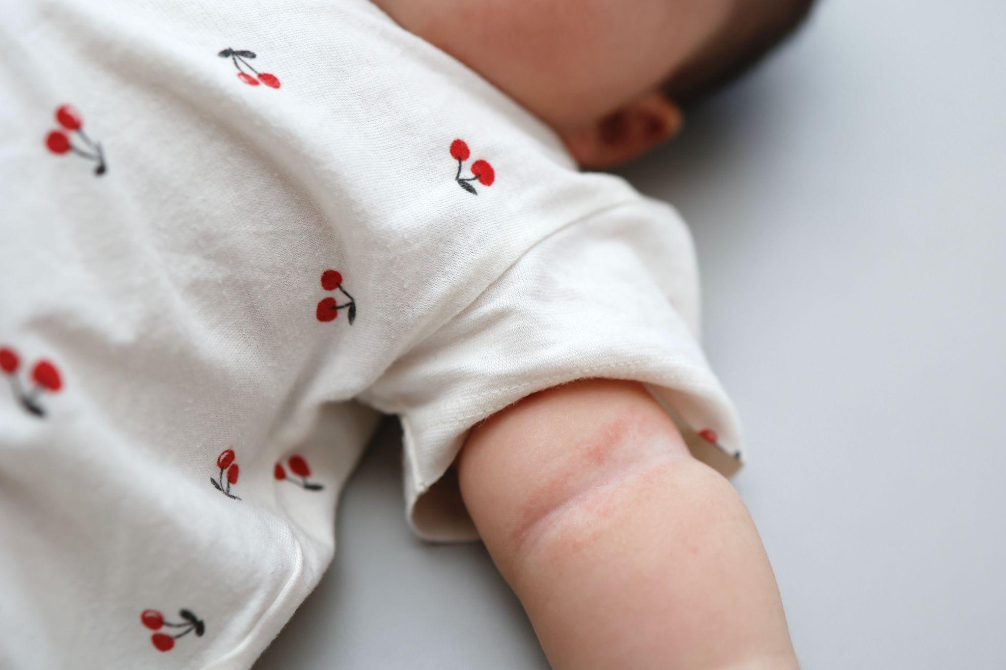 赤ちゃんのアトピーの症状とは？原因から対策まで医師が解説