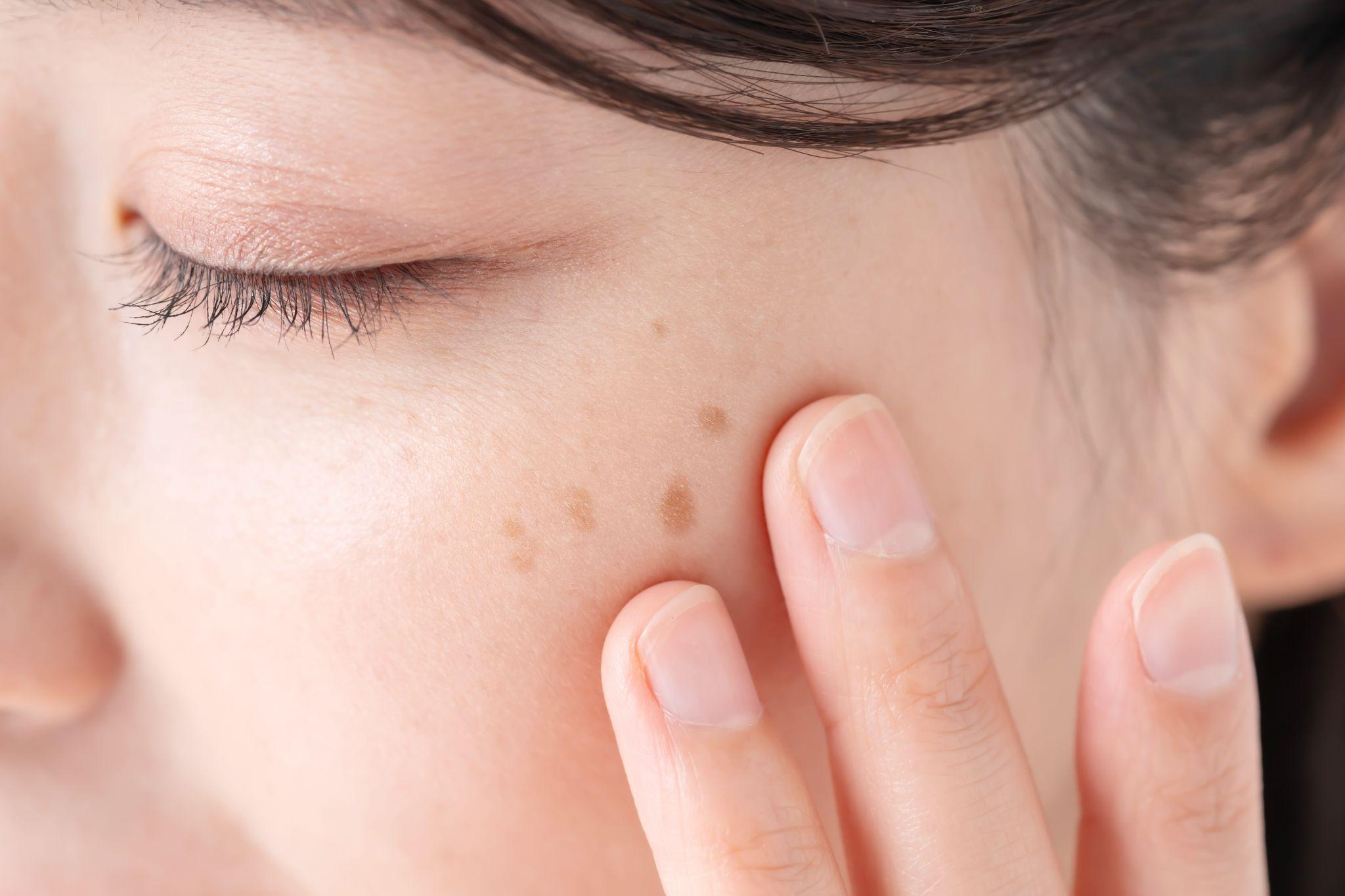 シミ取りレーザーの料金相場は？種類ごとの回数と総額