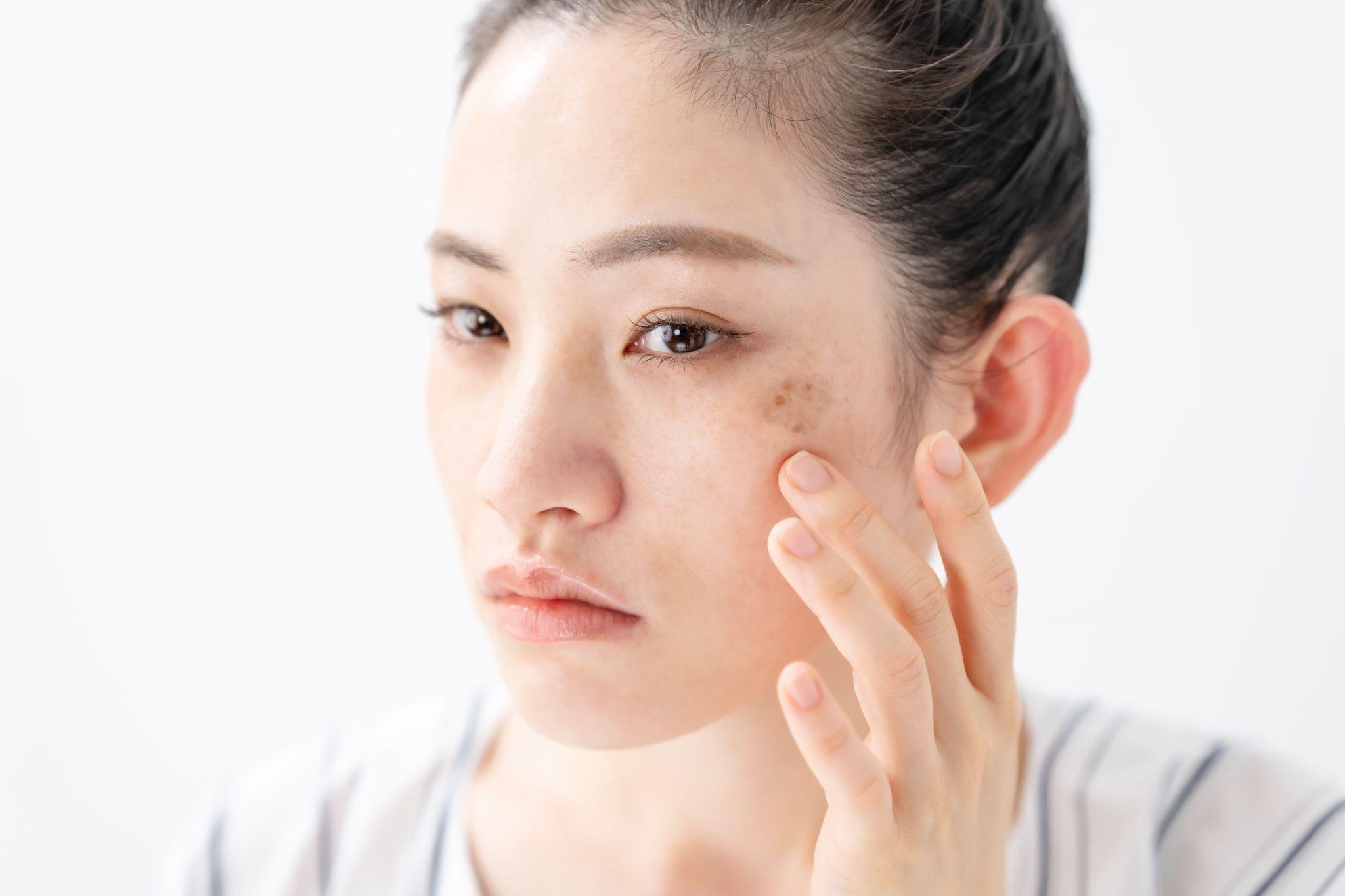 シミ取りレーザー後の色素沈着が半年続く理由と早く治す方法