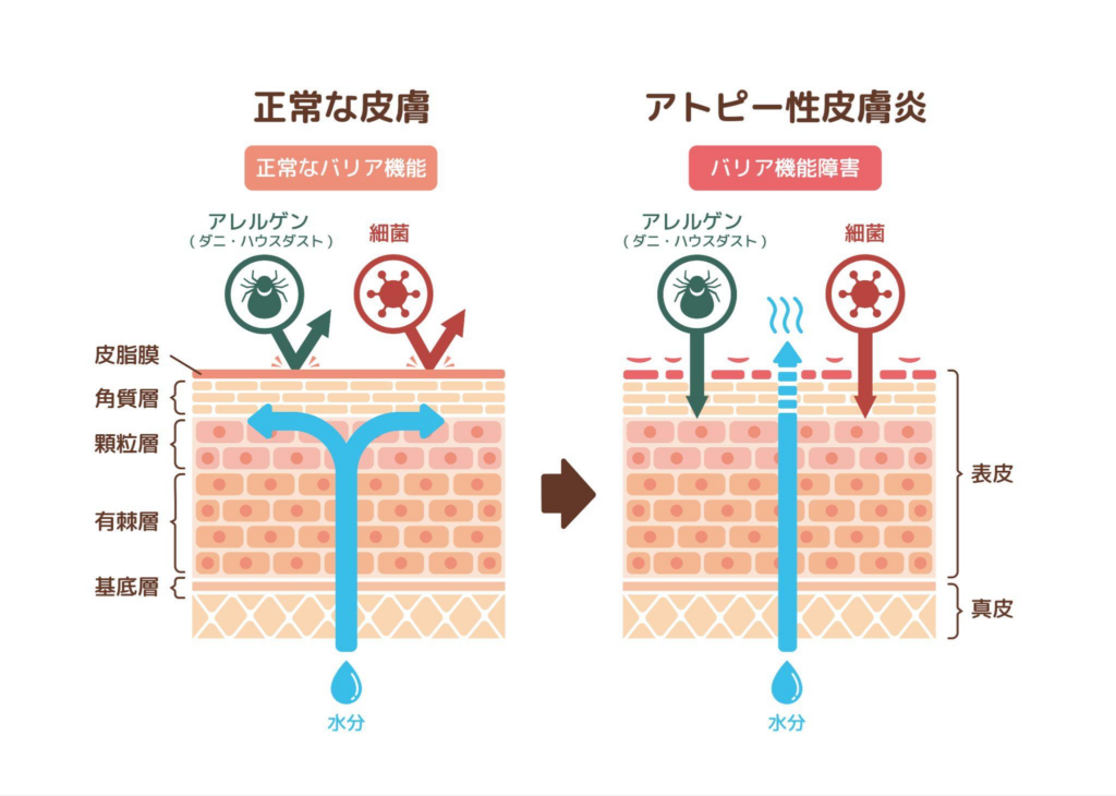 皮膚のバリア機能の低下
