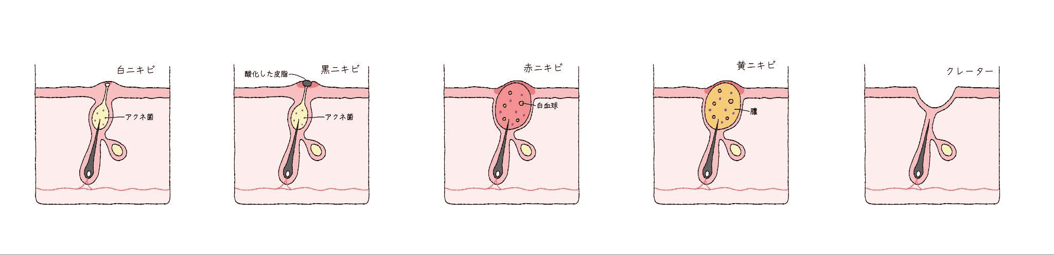 ニキビ跡の凹凸（クレーター）とは?